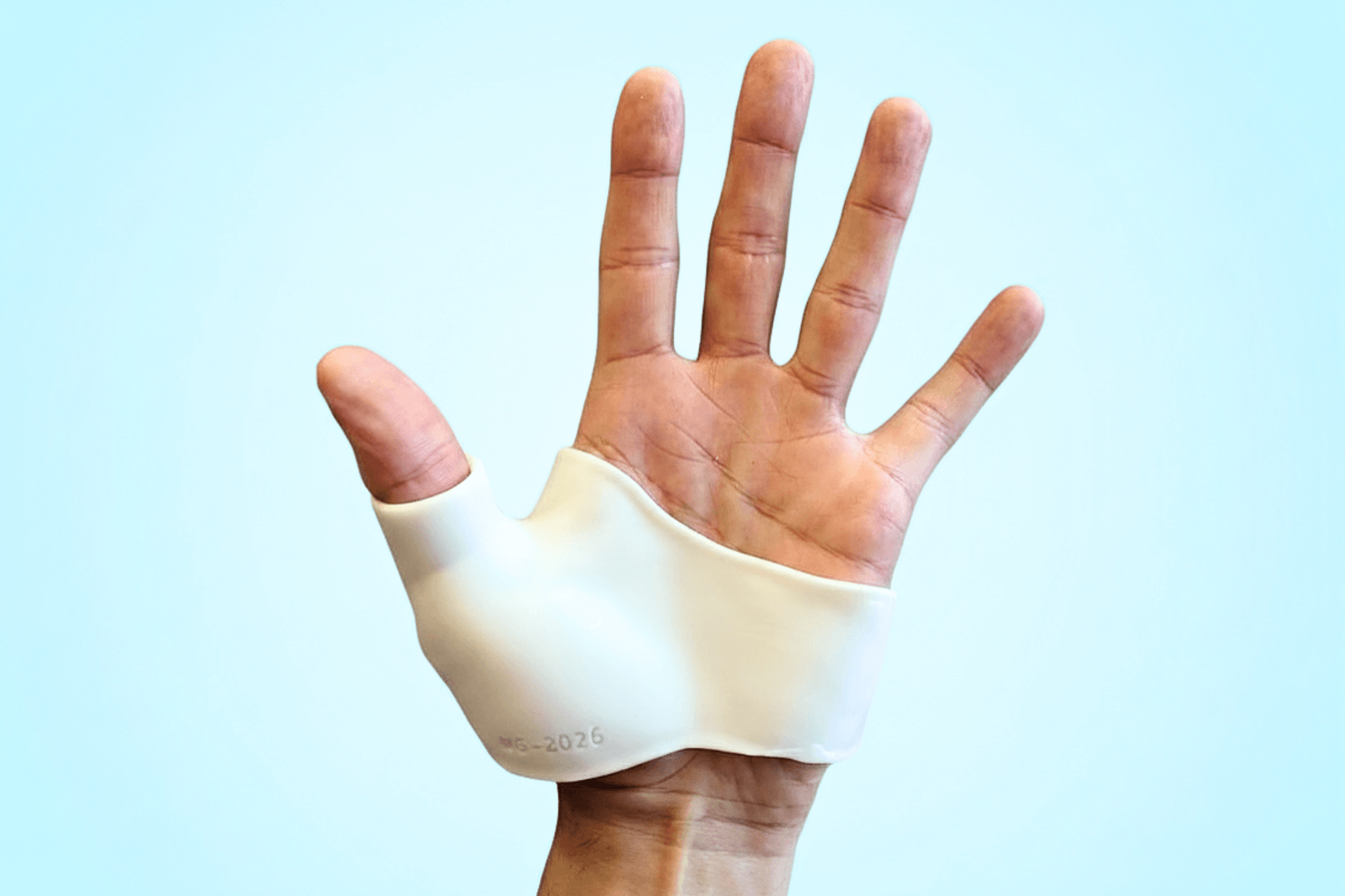 Custom 3D printed splint on a patient's forearm